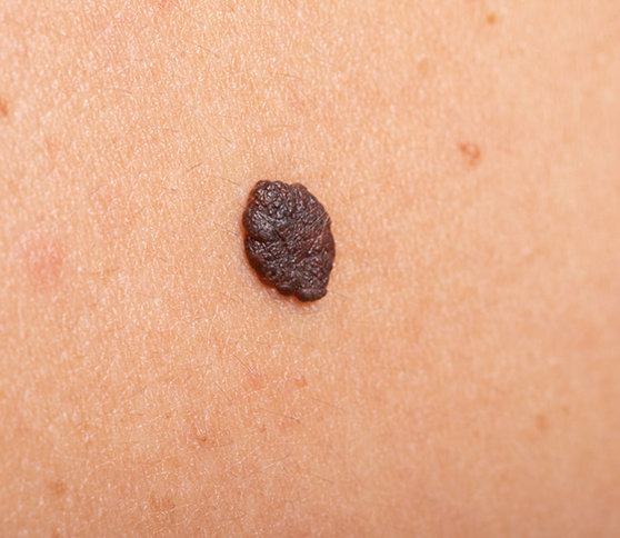 Cáncer de piel melanoma