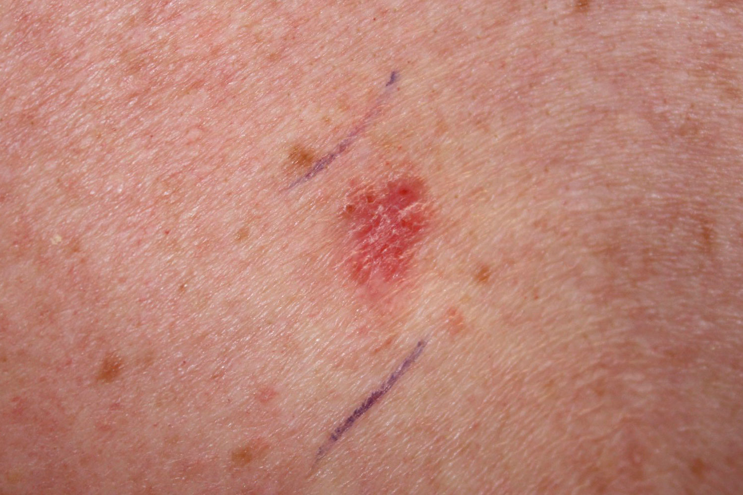 Carcinoma basoceluar