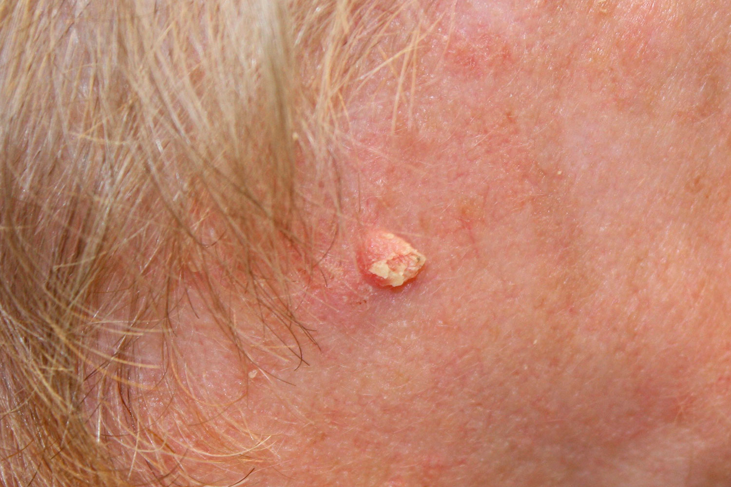 Carcinoma basoceluar