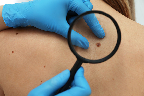 Factores de riesgo cáncer de piel