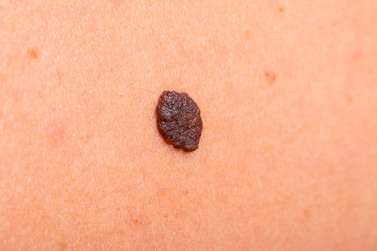 Cáncer de piel tipo melanoma