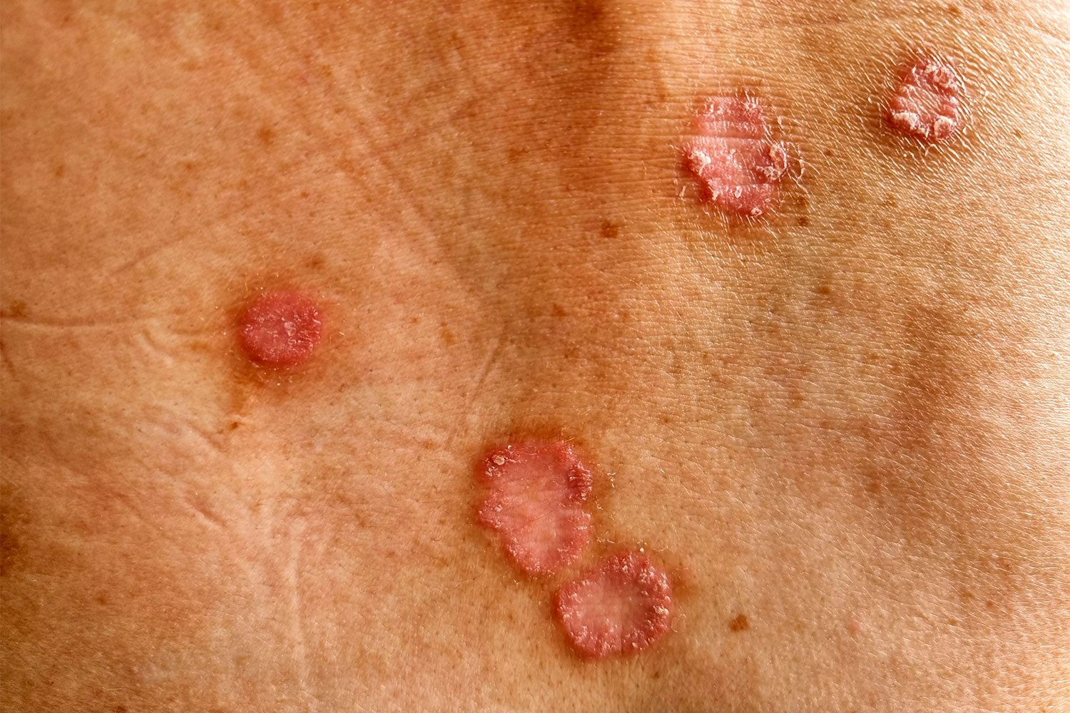 Cáncer de piel tipo no melanoma